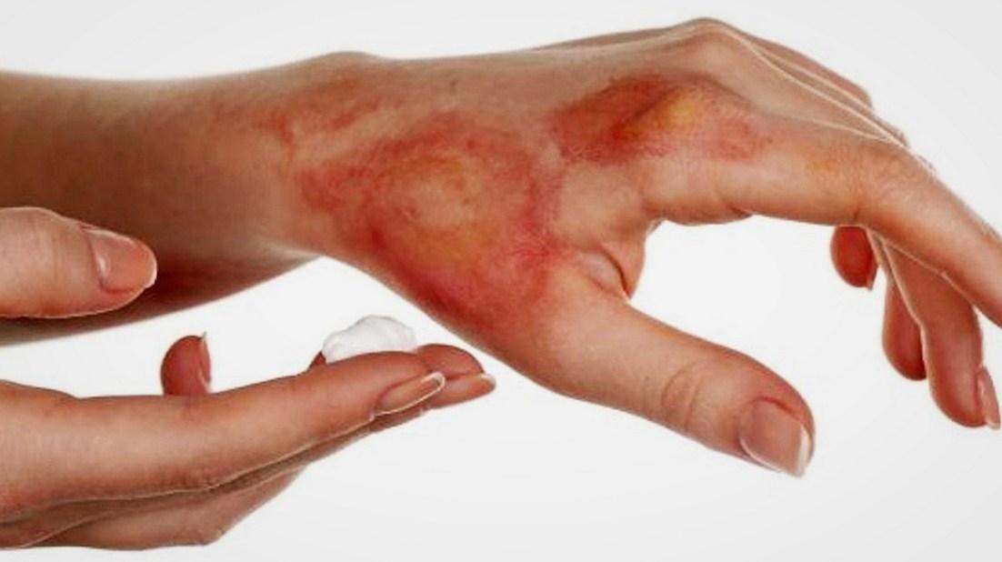 Влажная кожа – одна из причин электротравм и электроожогов кистей рук
